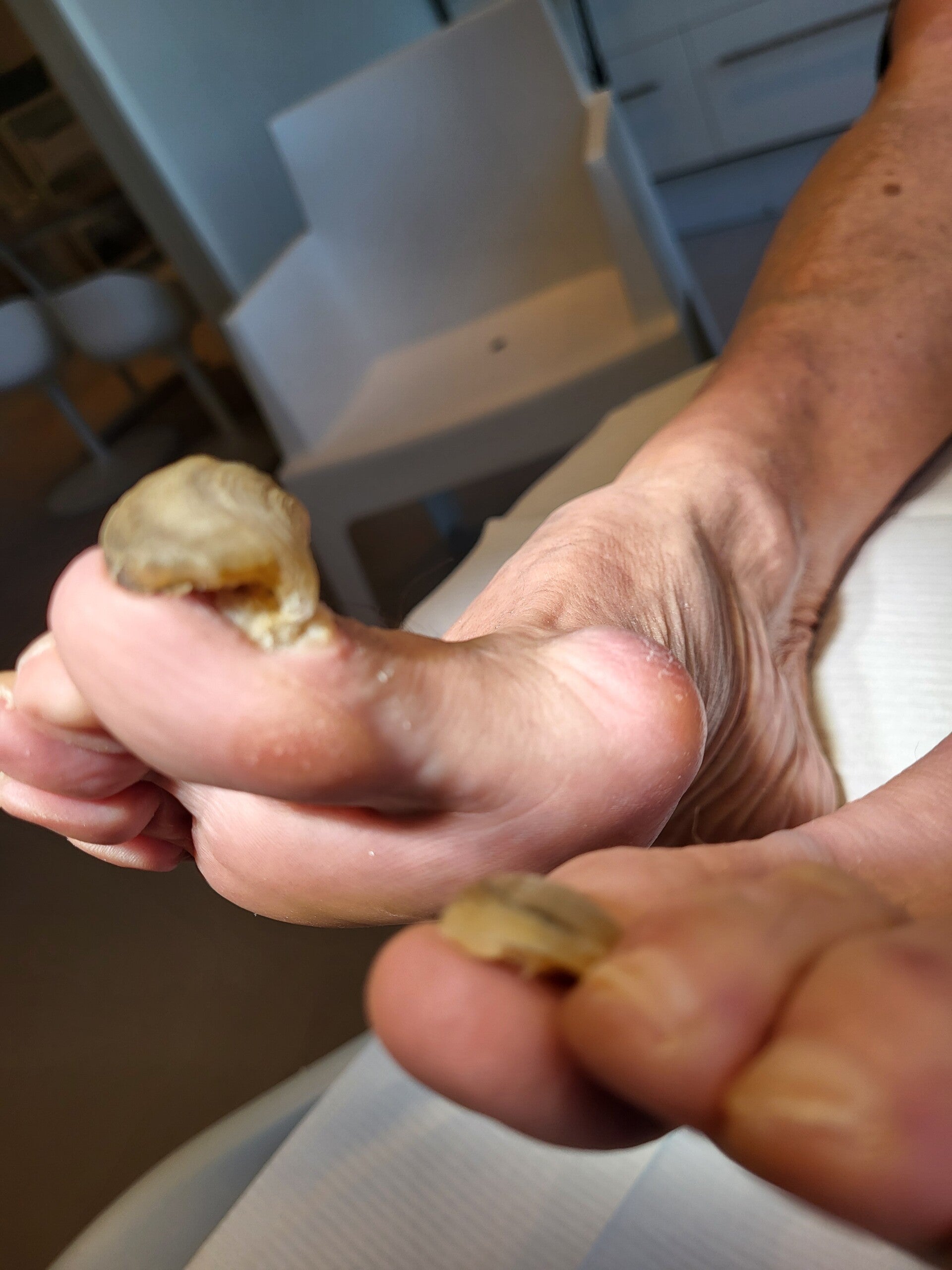 Voor (onychogryphose)