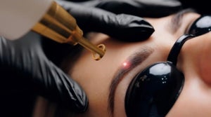 Laser eyebrow tattoo removal