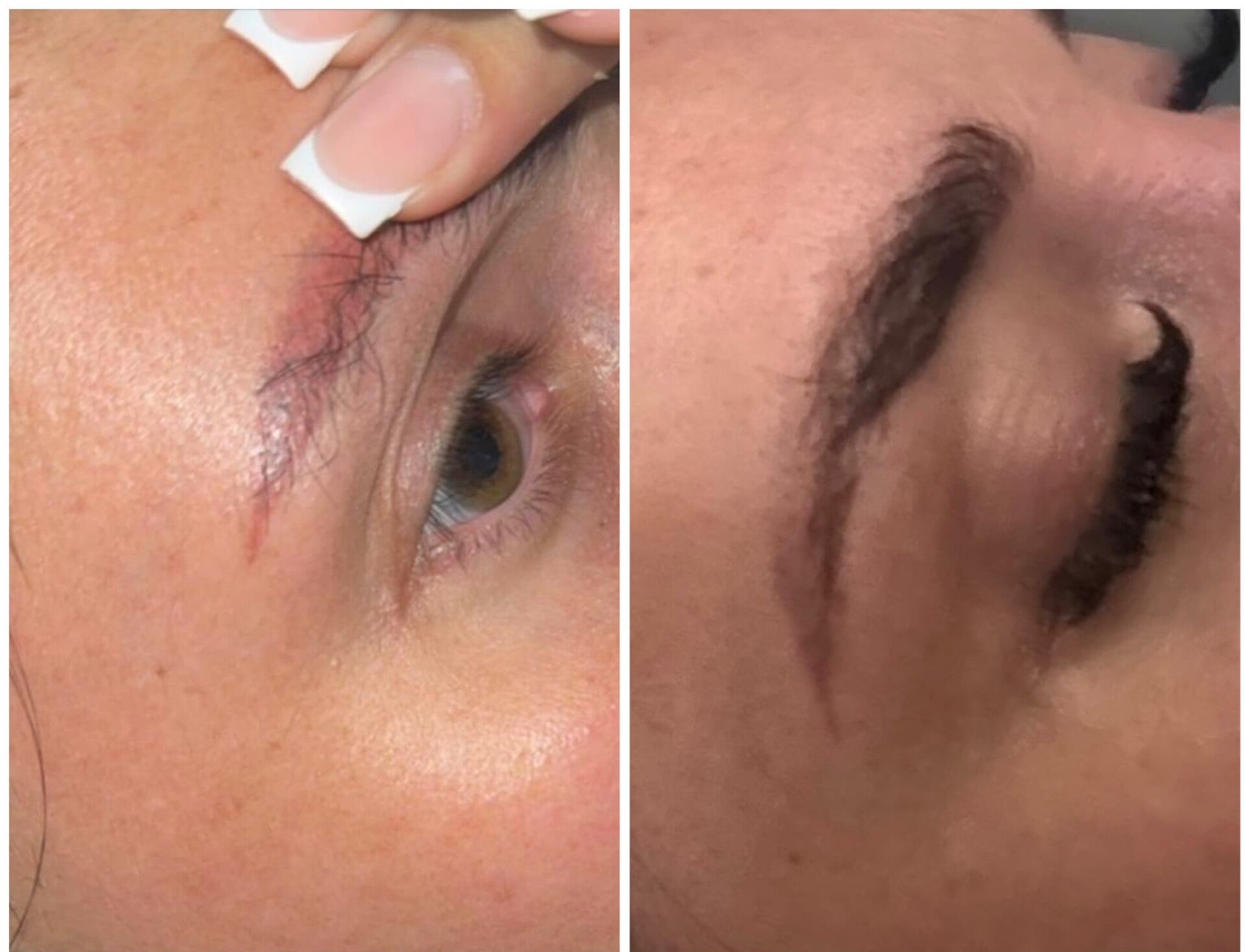 Client photographs showing eyebrow pigment appearance during a removal journey