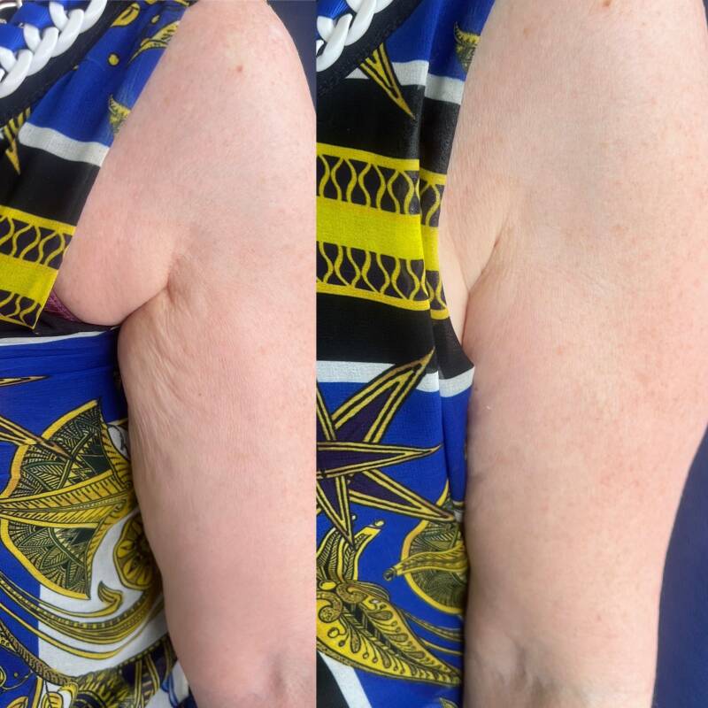 Non-surgical body contouring in Bolton – client receiving cavitation ultrasound treatment