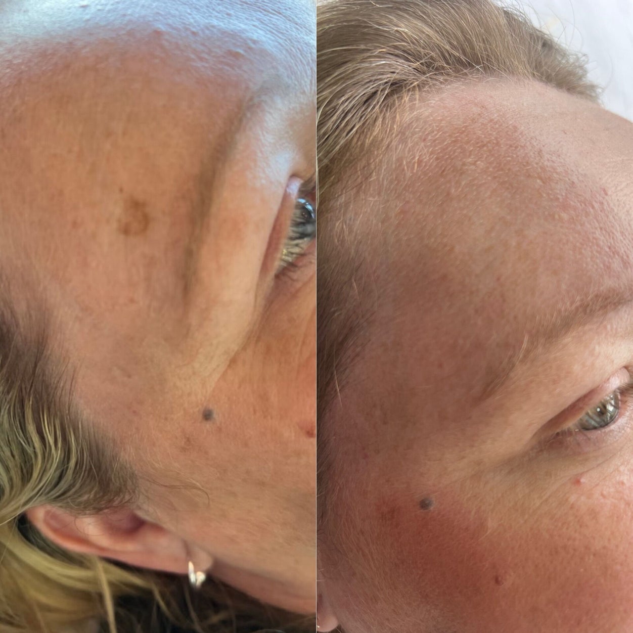 Skin Tag Removal Chorley before and after