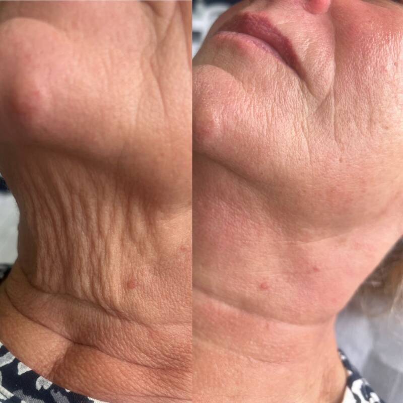 Individual Pulsar before and after image of the neck and jawline