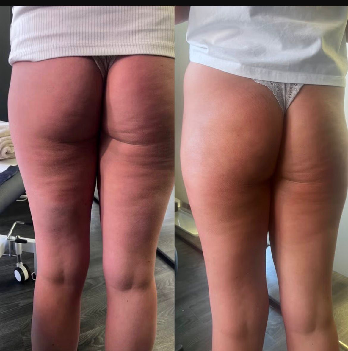 Cellulite Reduction Chorley before and after