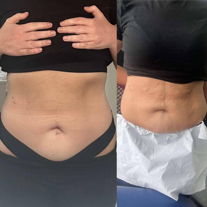 Non-surgical body contouring in Bolton – client receiving cavitation ultrasound treatment