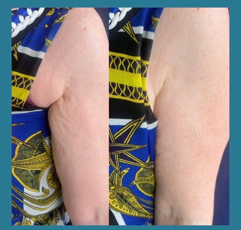 Side-by-side client photos showing the appearance of the upper arm