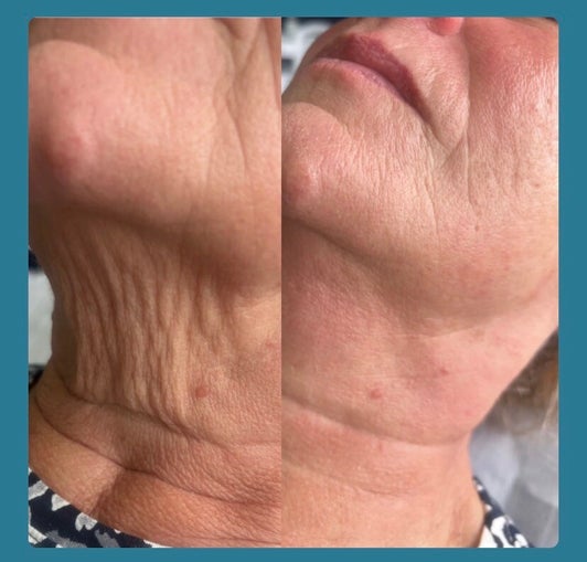 Jawline Contouring Chorley before and after