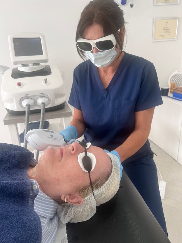 IPL facial redness and rosacea treatment