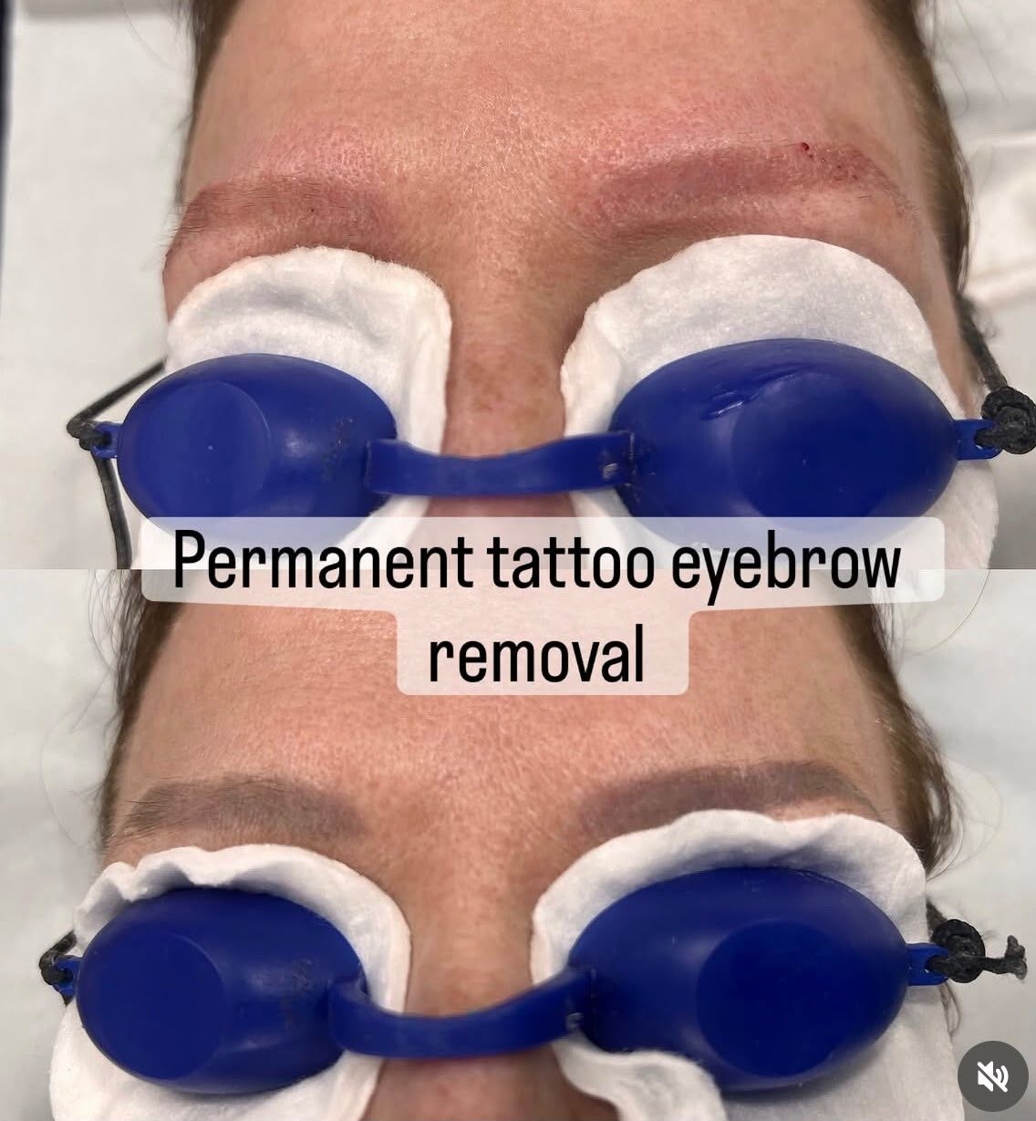 Eyebrow tattoo removal treatment photographs with protective eyewear
