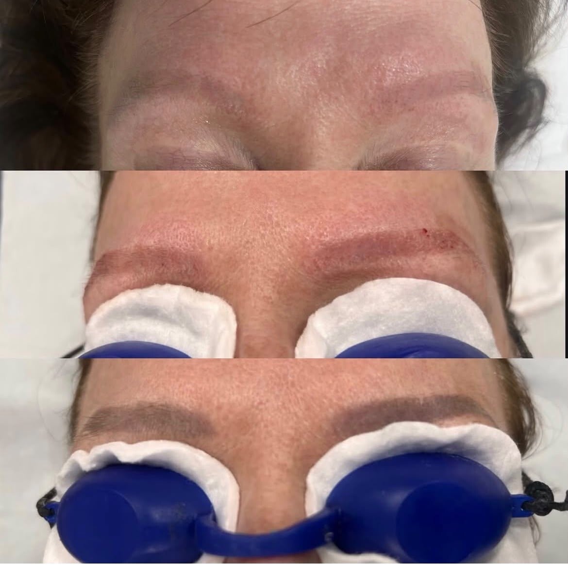 Eyebrow tattoo pigment and treatment-stage comparison photographs