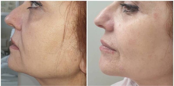LIFTING COSMETICO & FILI LIQUIDI