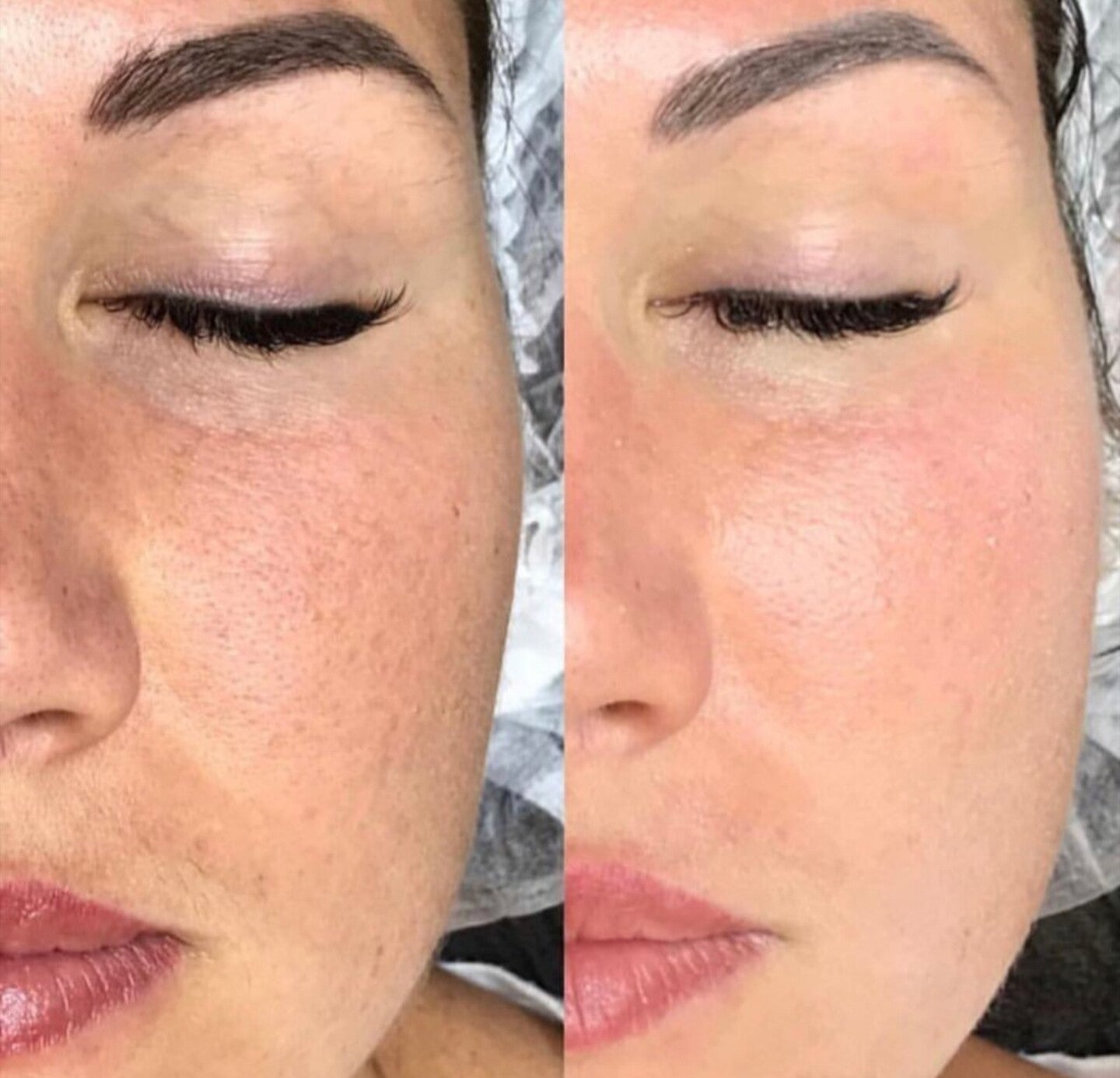 TUTTO MICRO-NEEDLING