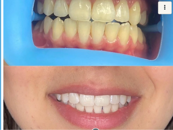 Blanchiment dentaire White ou Extra white