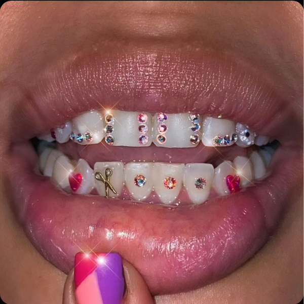 💎 Pose de strass dentaire