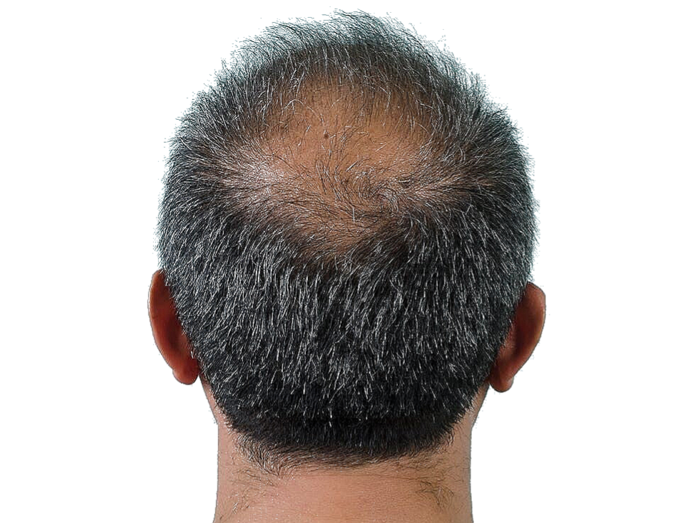Hair Loss Treatment