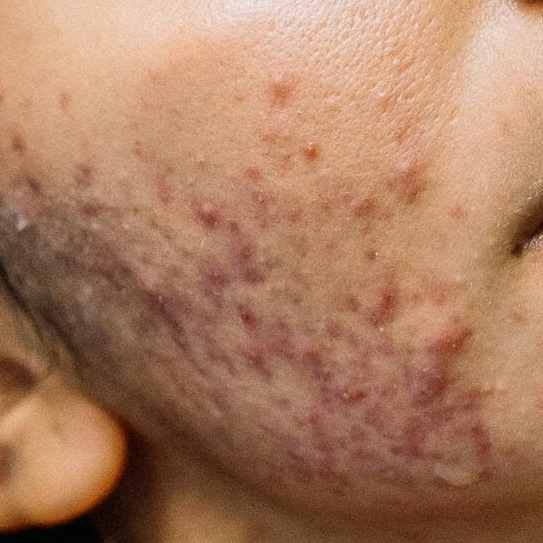 Acne