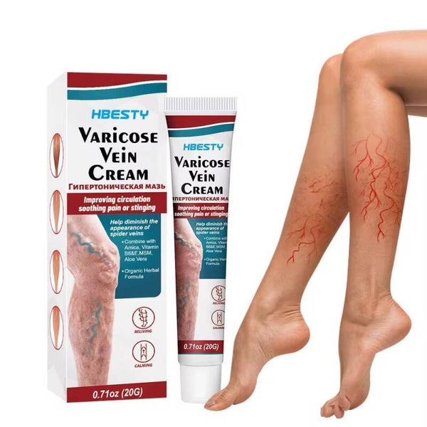 varicose