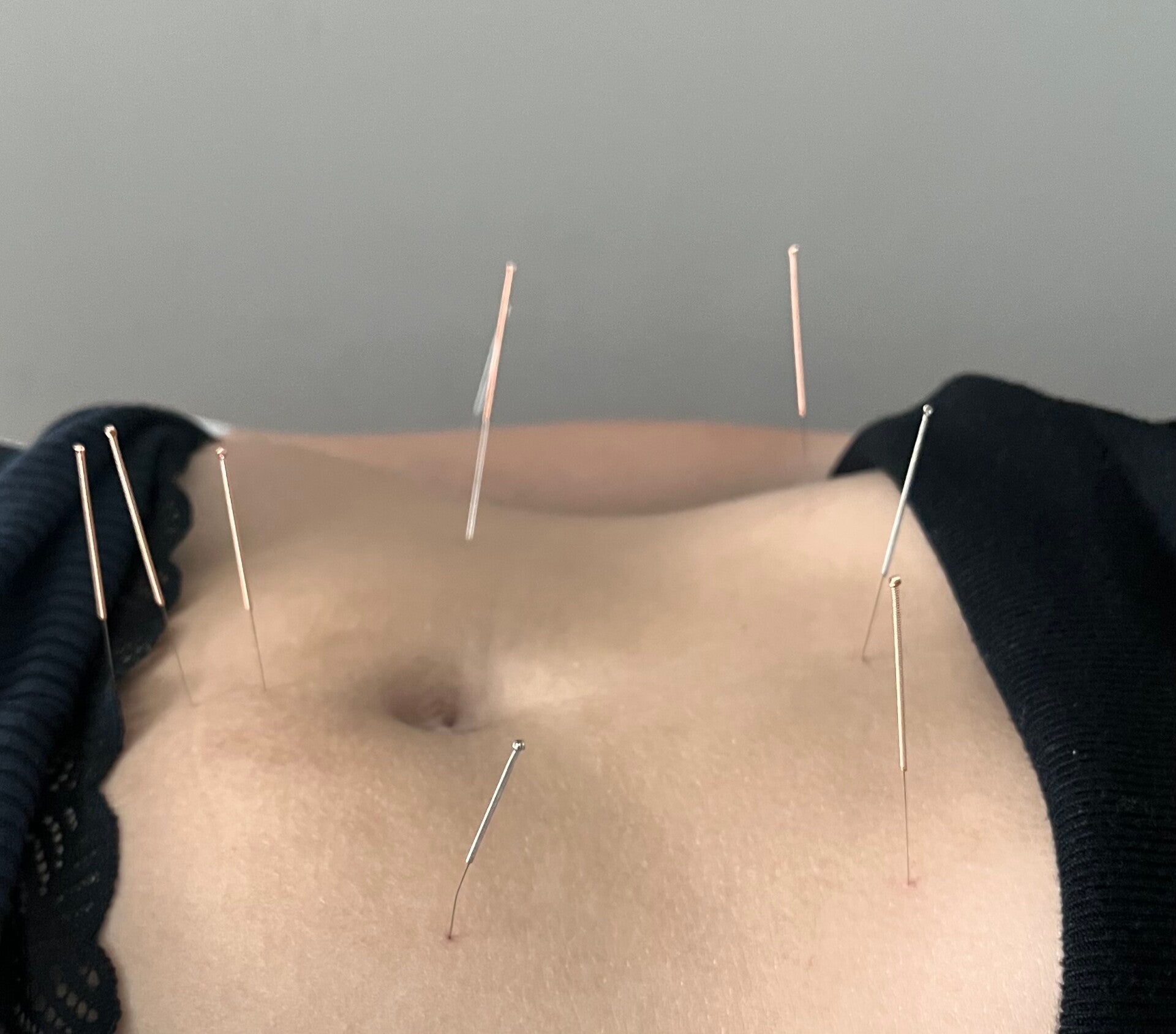 acupuncture stress et tensions nerveuses