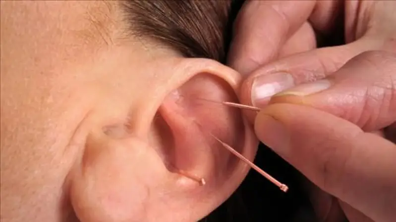 Auriculothérapie stress