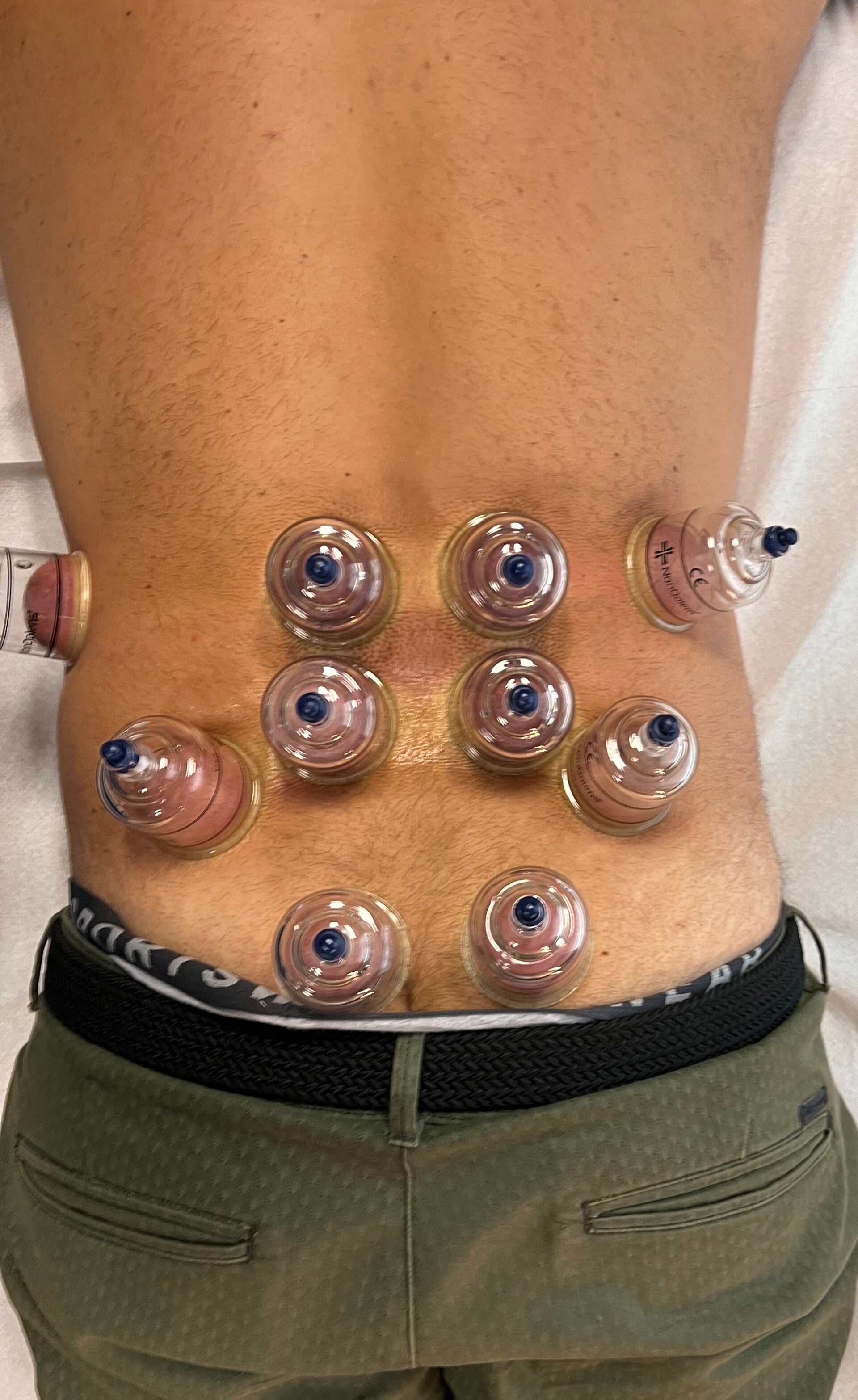 Ventouses doulerus musculaires