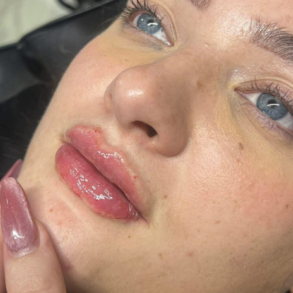 Lip Fillers