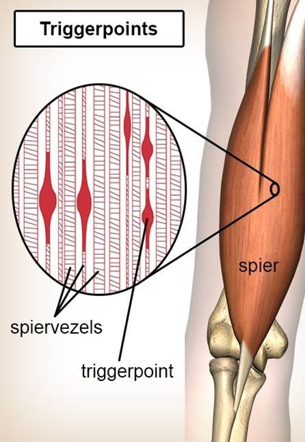 Triggerpointherapie