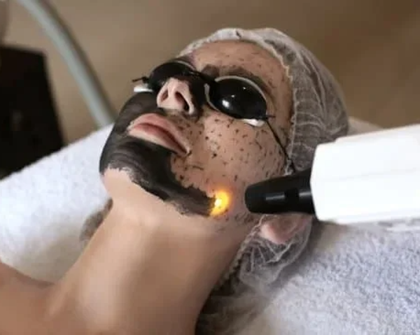 LASER Q-SWITCHED (CARBON PEEL) desde