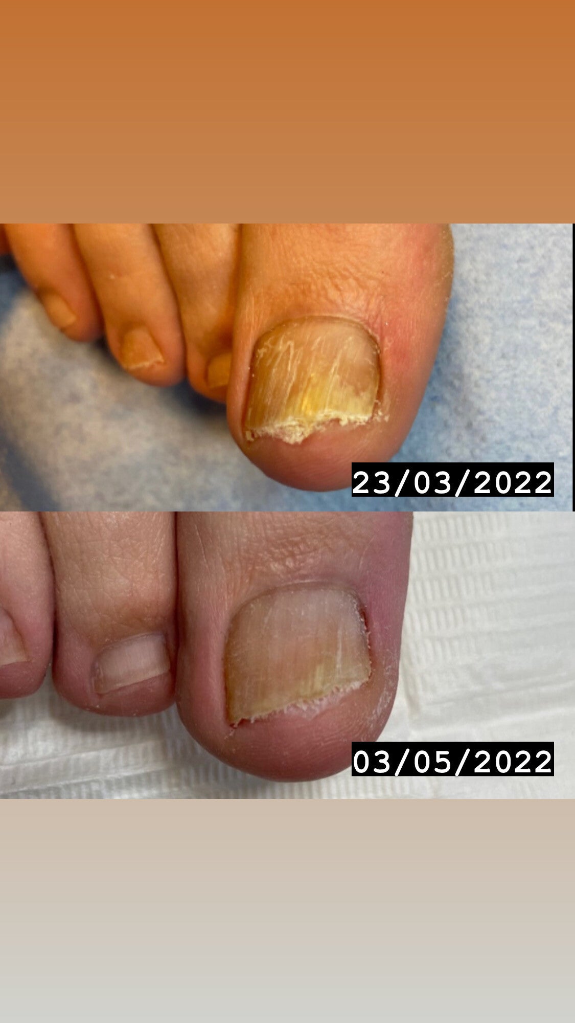 laser-schimmelnagels-guylina-beauty-i-gespecialiseerde-voetverzorging