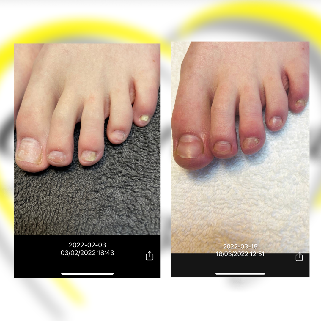 laser-schimmelnagels-guylina-beauty-i-gespecialiseerde-voetverzorging