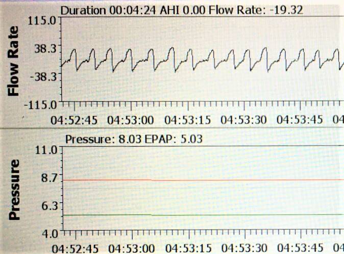 Oscar software print out from a CPAP machine set with EPR of 3