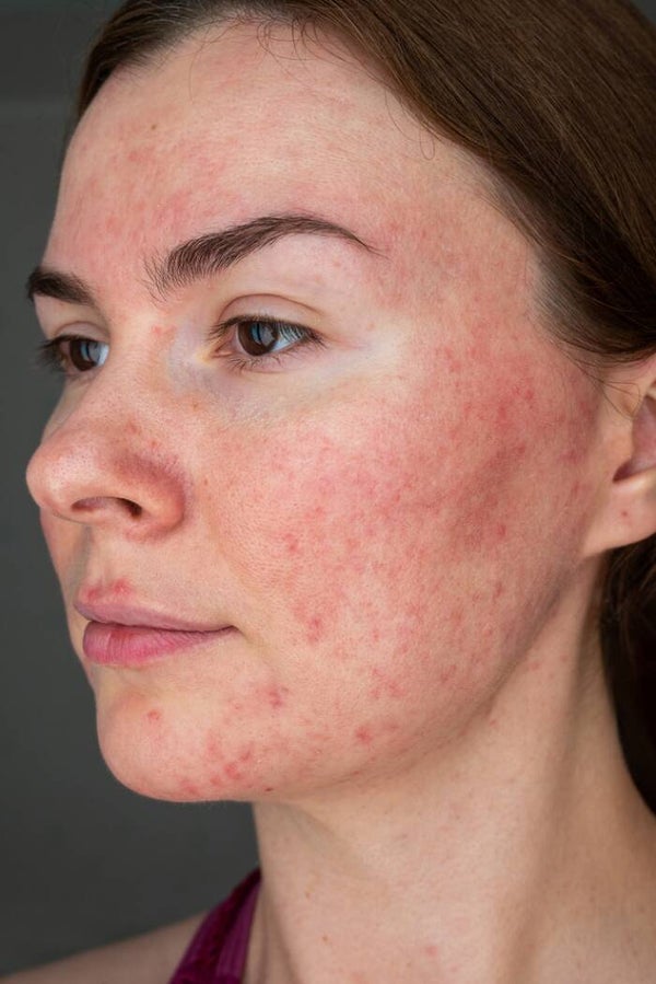 Rosacea Box