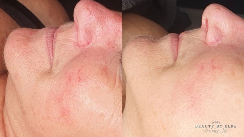 Resultaat Bio Peel bij roodheid-Eindhoven