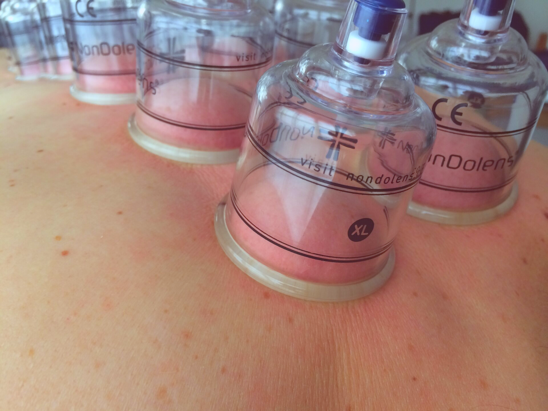 cupping