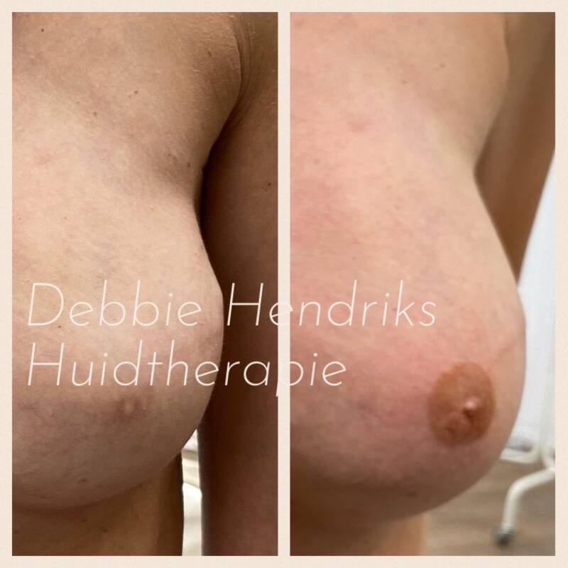 Tepelpigmentatie/tatoeage Alkmaar