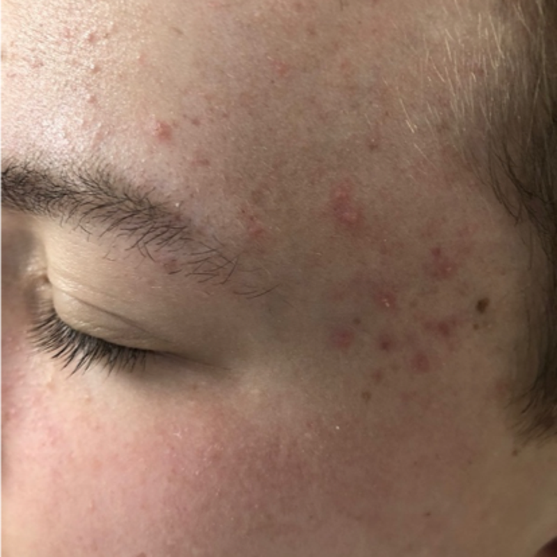 Acne behandeling Alkmaar