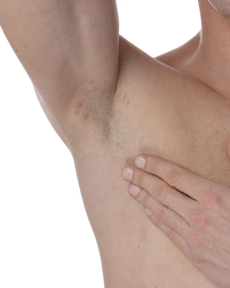 Laser ontharen Alkmaar 