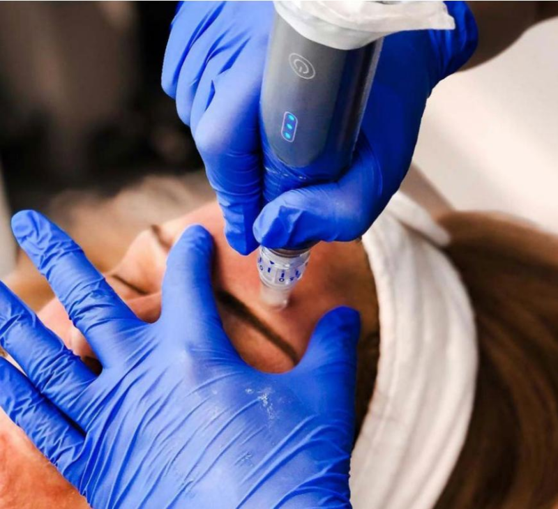 Microneedling Skinpen Alkmaar