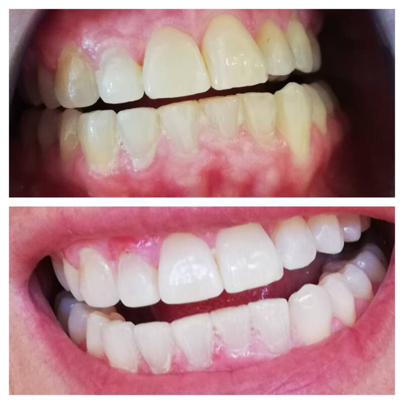 Tanden bleken Haarlem