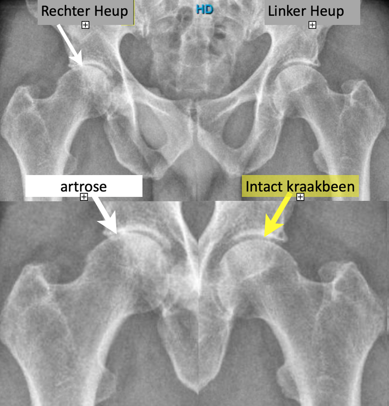 Heup Artrose Hogervorstheup nl heup-artrose-hogervorstheup-nl