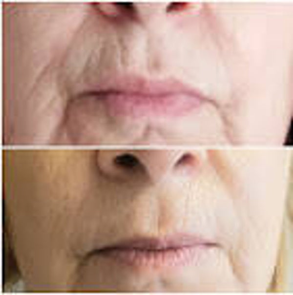 Cure anti-âge radiofréquence