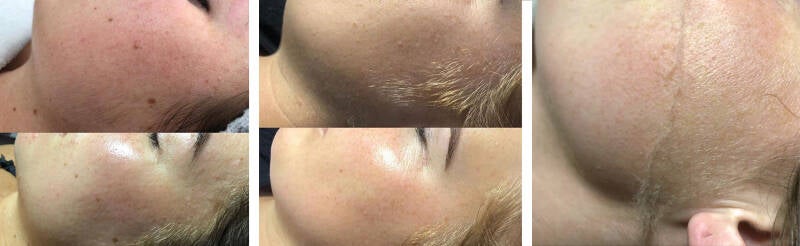 Gezichtshaar verwijderen Friesland