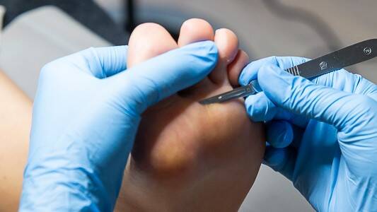 Eelt verwijderen pedicure Sneek