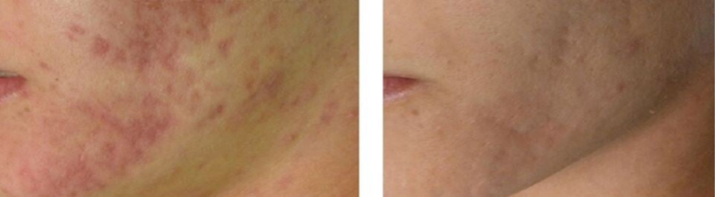 Acnelittekens verminderen Sneek