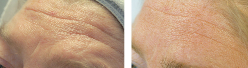 Rimpelvermindering schoonheidsspecialiste