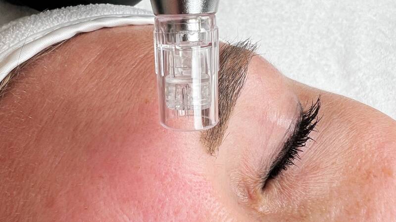 Gladdere huid door behandeling bij PUUR Fiona Sneek