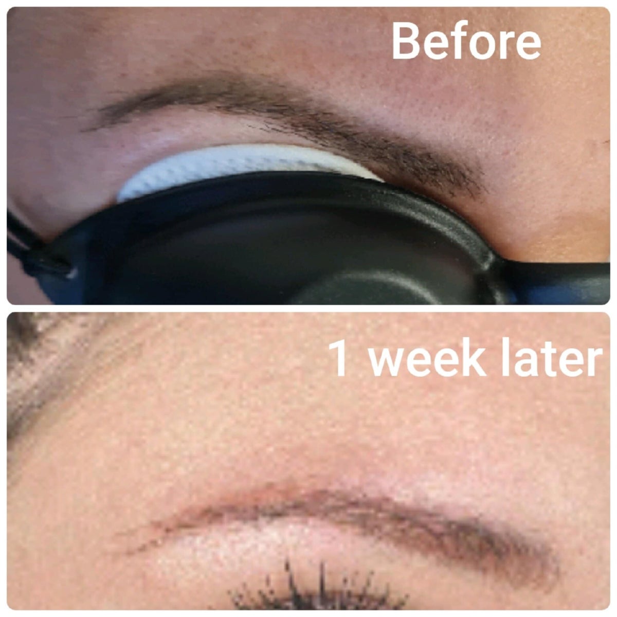 Delete Tattoo Removal And Laser Salon