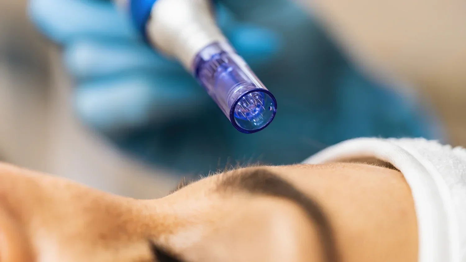 microneedling behandeling