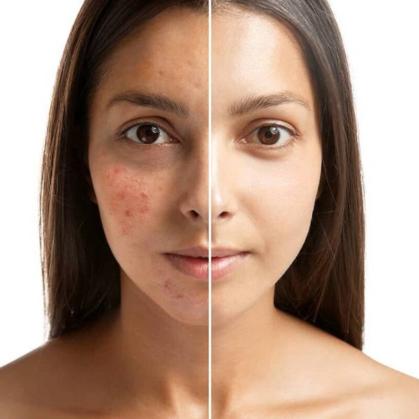 Acne Scar Removal / Stretch Mark Removal