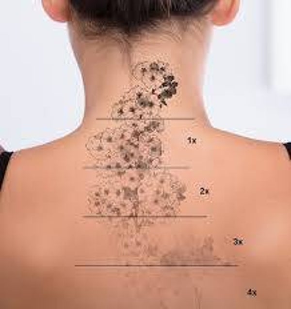 Tattoo Removal