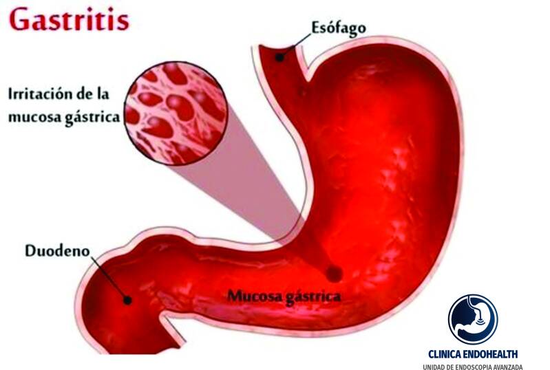 GASTRITIS / HELICOBACTER PYLORI / ENDOSCOPÍA / PROC. ENDOSCÓPICOS