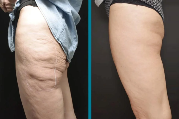 Fat & Cellulite Removal Spell Casting Safe White Witch Magick Thighs Tummy Skin